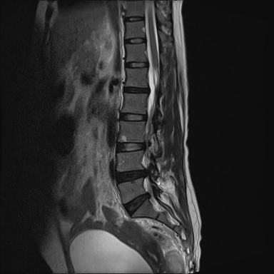 Viêm khớp liên mấu (Facet joint septic arthritis)