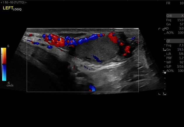 Nang bao trắng bìu (Tunica albuginea cyst)