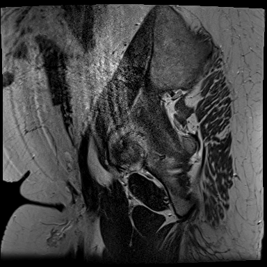 MRI tử cung phần phụ