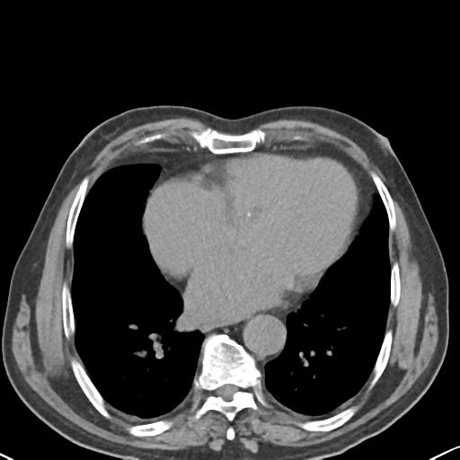 Xuất huyết tiêu hóa dưới (Lower gastrointestinal bleeding - LGIB)