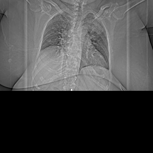 Bệnh lupus ban đỏ hệ thồng (biểu hiện ở ngực) - Systemic lupus erythematosus (thoracic manifestations)