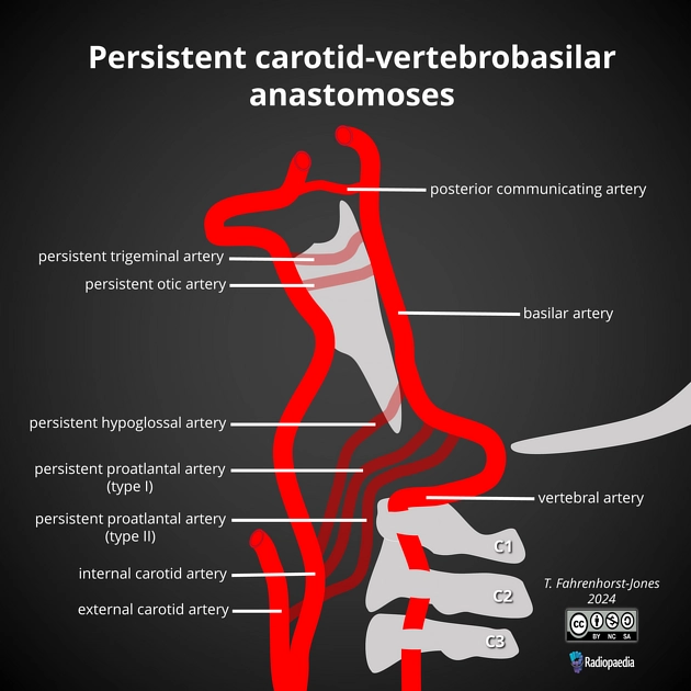 Tồn tại động mạch sinh ba nguyên thủy (Persistent primitive trigeminal artery - PTA)
