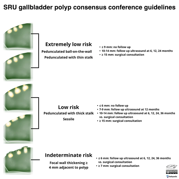 Polyp túi mật (Gallbladder Polyps)