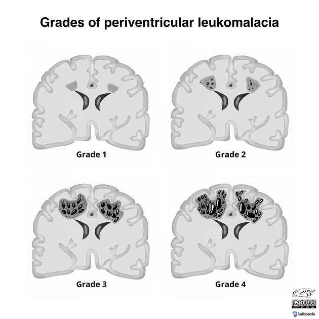  Tổn thương chất trắng ở trẻ non tháng (White Matter Injury of prematurity-WMI)/ Nhuyễn não chất trắng quanh não thất (Periventricular leukomalacia)