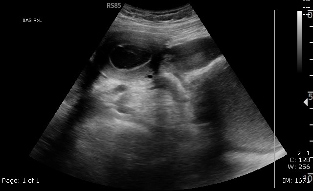 Bất sản 1/3 dưới âm đạo (Lower vaginal atresia)