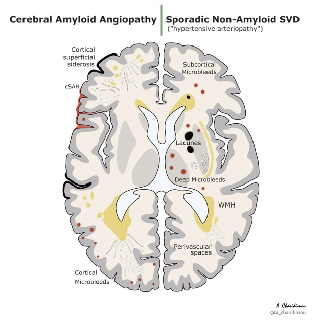 Bệnh vi mạch não dạng bột (Cerebral amyloid angiopathy - CAA)