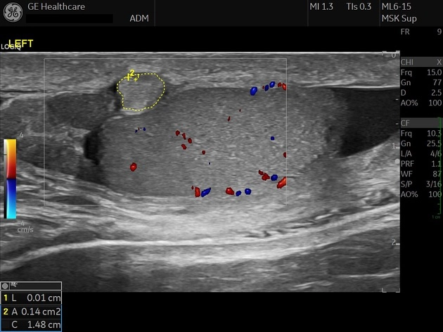 U mỡ cạnh tinh hoàn (Peritesticular lipoma)