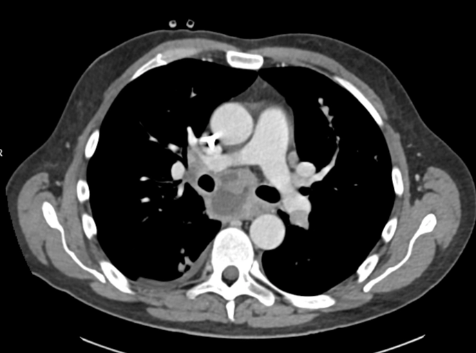 Thuyên tắc do u (Tumor Emboli)