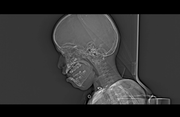 U xơ thể xơ cứng của xương (Desmoplastic fibroma of bone)