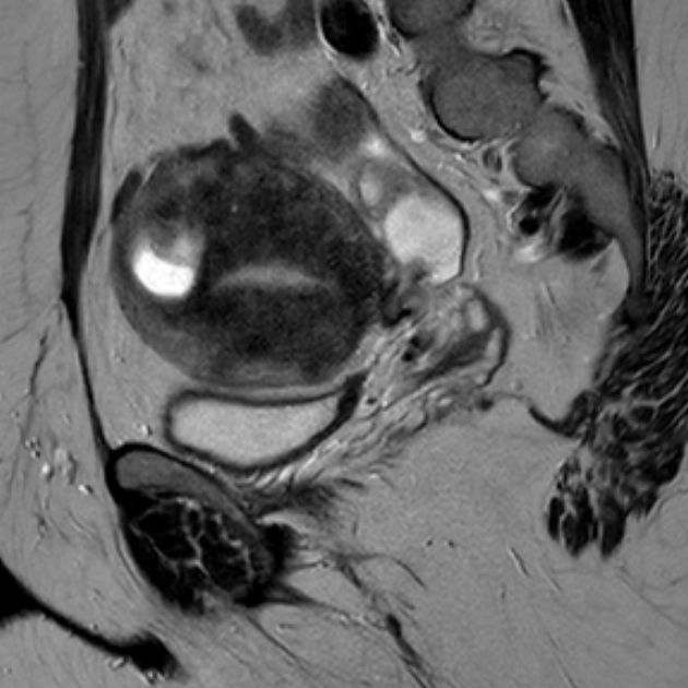 Bệnh cơ tuyến tử cung dạng nang (Cystic adenomyosis)