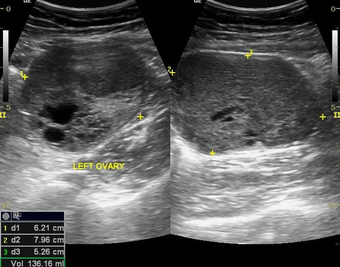 U tế bào Sertoli-Leydig buồng trứng (Sertoli-Leydig Cell Tumor - SLCT)