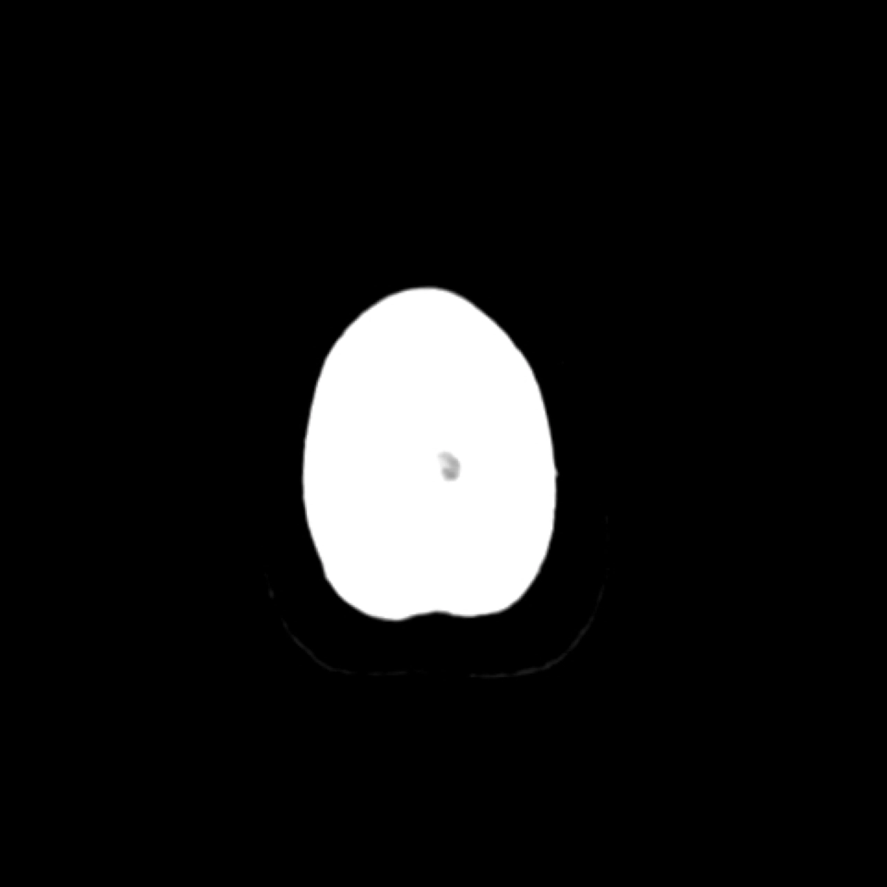 CT Tĩnh mạch đầu