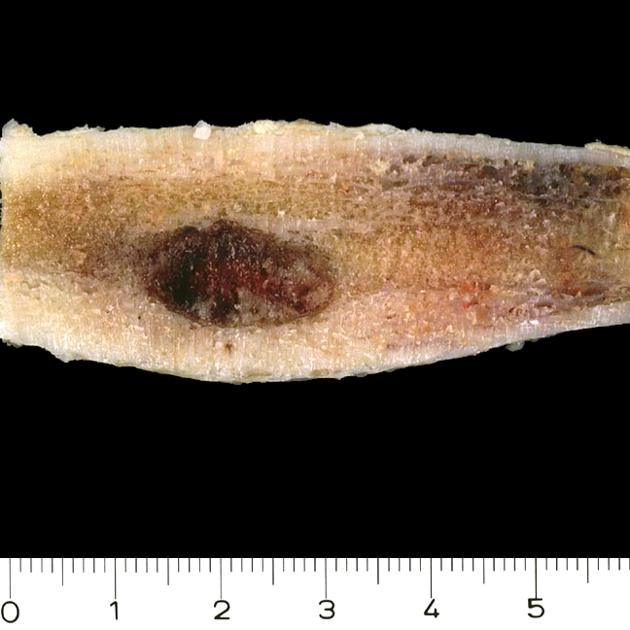 U xương dạng xương (Osteoid osteoma) 