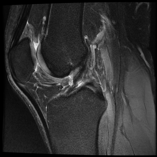 Rách dây chằng chéo trước (ACL) mạn tính