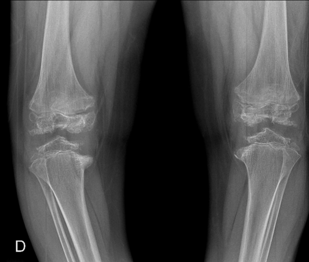 Loạn sản đa đầu xương (Multiple Epiphyseal Dysplasia - MED)