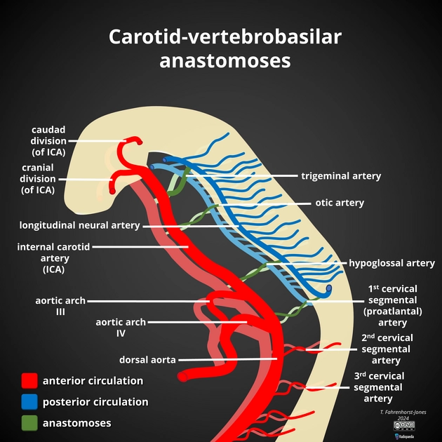 Tồn tại thông nối động mạch cảnh-nền (Persistent Carotid Basilar Anastomoses)
