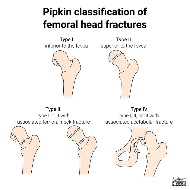 Gãy chỏm xương đùi (Femoral Head Fracture)