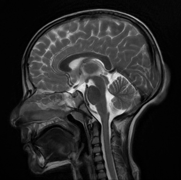 U sợi hyaline ở trẻ vị thành niên (Juvenile hyaline fibromatosis)