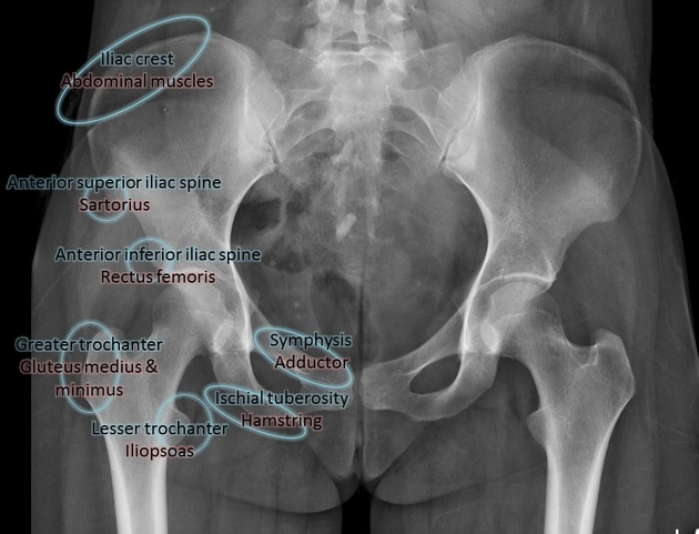 Gãy xương chậu (Pelvic fractures)