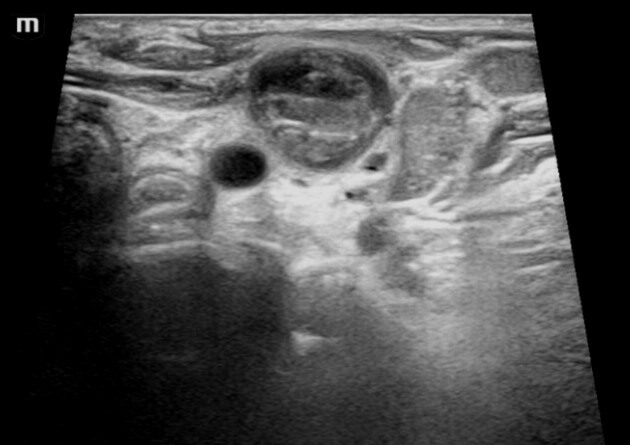 Huyết khối tĩnh mạch cảnh (Jugular Vein Thrombosis - JVT)