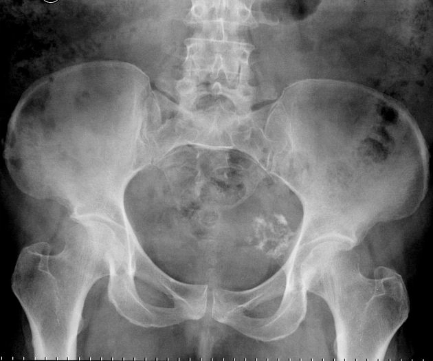 Gãy xương đùi liên quan đến bisphosphonate (Atypical femoral fracture)