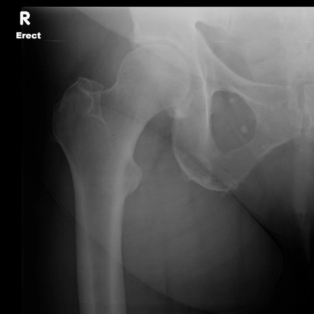 Thoái hóa khớp háng tiến triển nhanh (Rapidly destructive osteoarthritis of the hip)