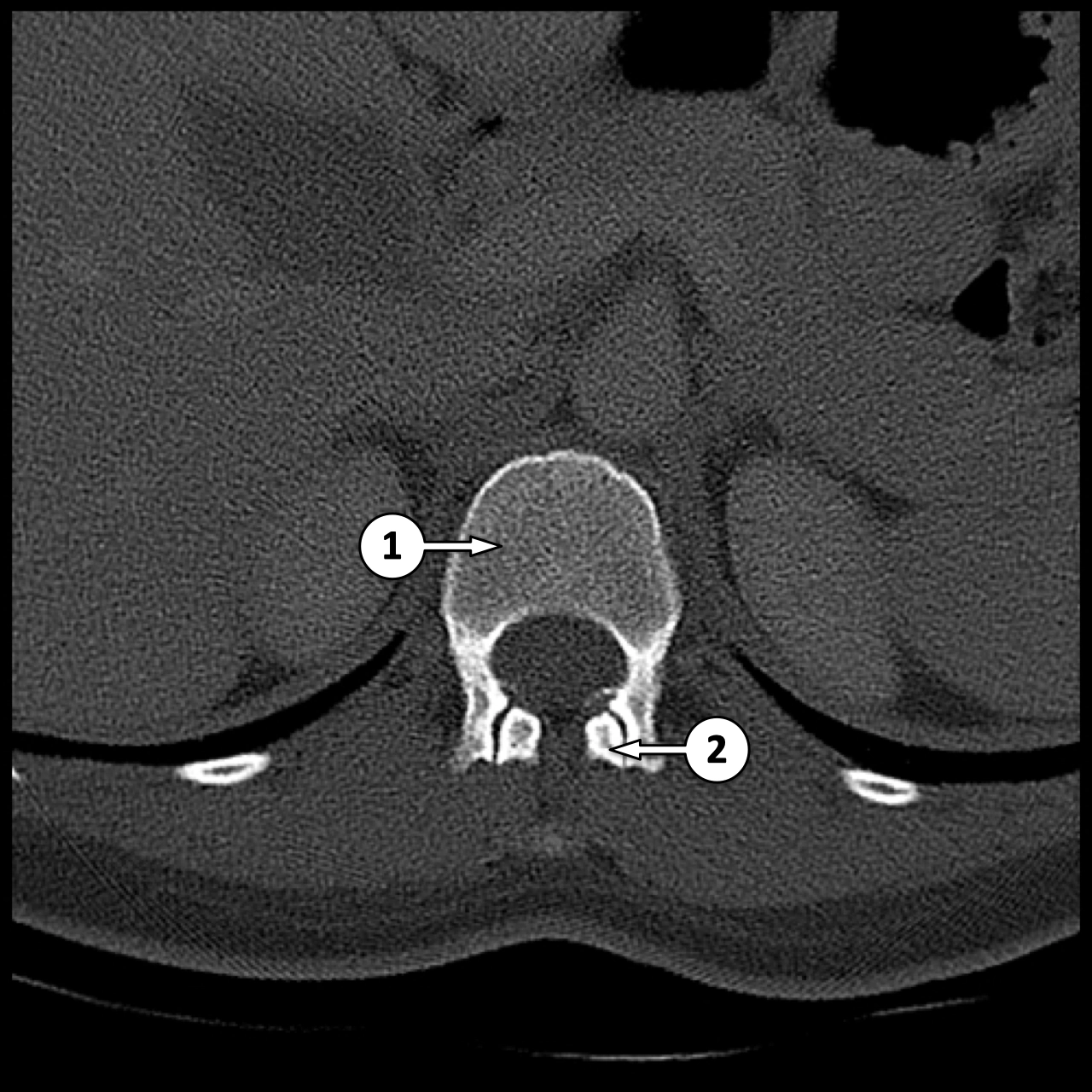 CT cột sống thắt lưng