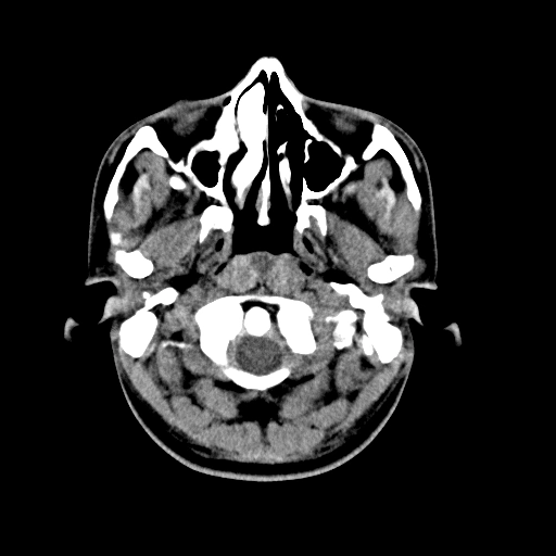 Loạn sản sợi ở mũi xoang (Sinonasal Fibrous Dysplasia)