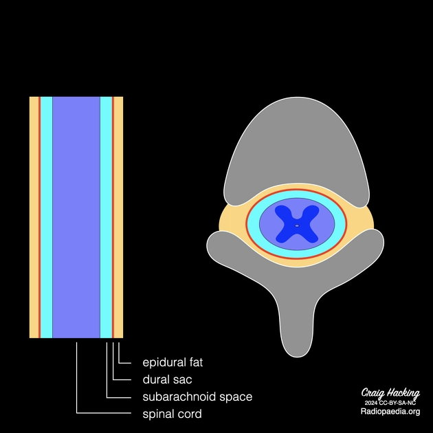 Phân loại u tủy (Neoplasms of the spinal canal)