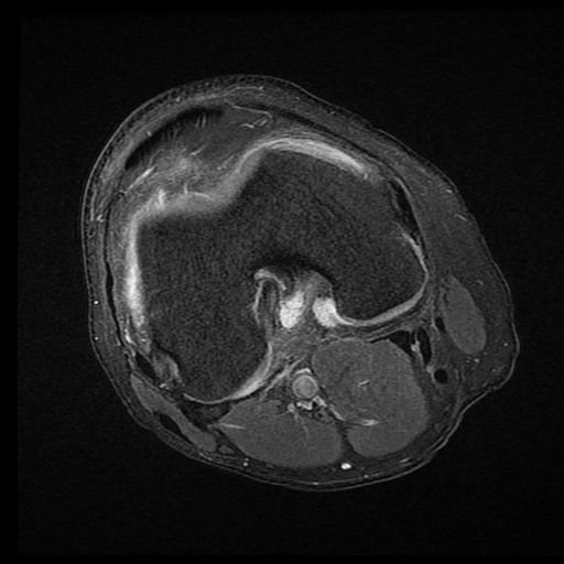 Hội chứng nếp gấp màng hoạt dịch phía trong khớp gối (Medial patellar plica syndrome)