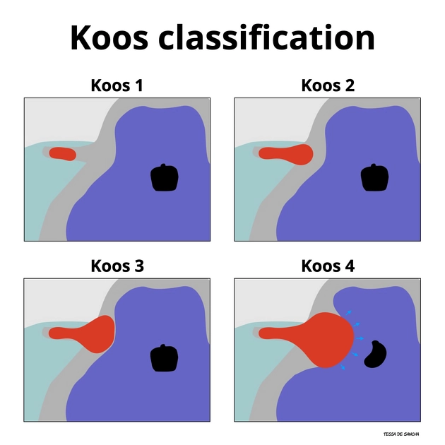 Phân loại Koos cho u schwannoma tiền đình - Koos classification of vestibular schwannomas