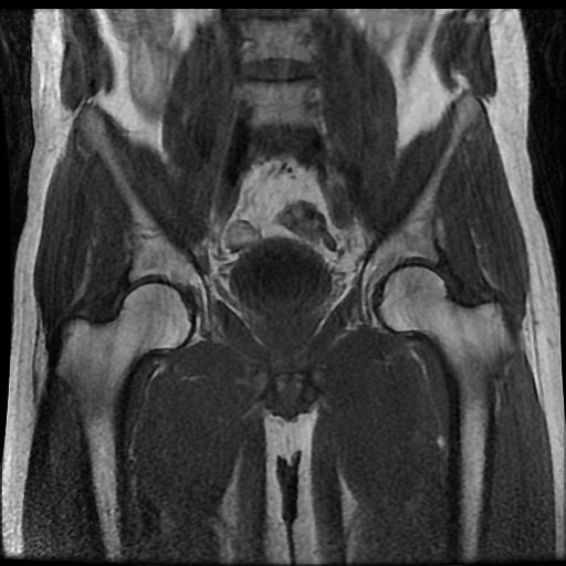 Tổn thương cơ khép dài (Adductor longus)(nhóm cơ khép háng)