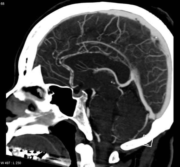Hội chứng co thắt mạch máu não có hồi phục (Reversible cerebral vasoconstriction syndrome - RCVS)
