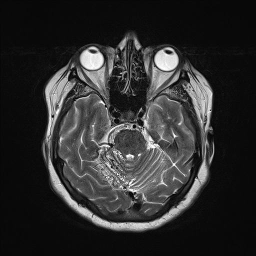Bệnh lý tăng sinh mạch máu não (Cerebral Proliferative Angiopathy - CPA)