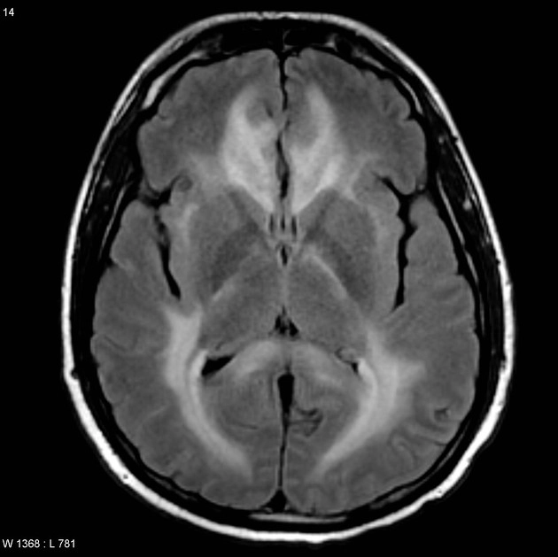 Tổn thương não do lạm dụng chất (Drug Abuse)