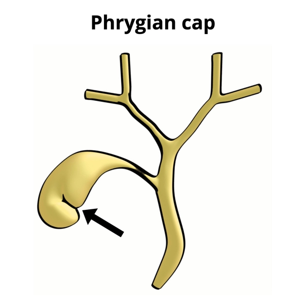 Túi mật hình mũ Phrygian (Phrygian Cap)