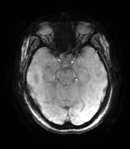 Thoát vị não vào hạt màng nhện (Brain herniation into arachnoid granulation - BHAG)