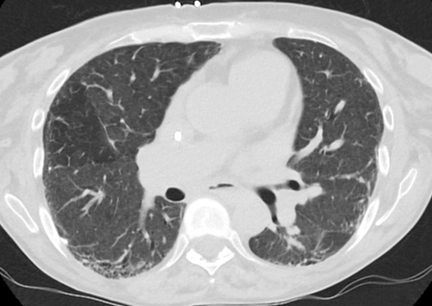 Bệnh mô liên kết hỗn hợp (Biểu hiện ở phổi) - Mixed connective tissue disease (pulmonary manifestations)