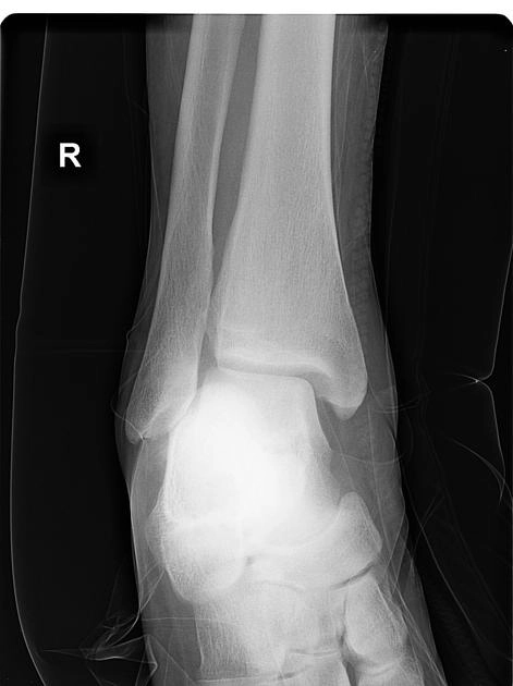Tổn thương dây chằng/ dải chày-mác dưới (Distal tibiofibular syndesmosis injuries) 