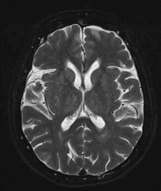 Viêm nội nhãn (Endophthalmitis)