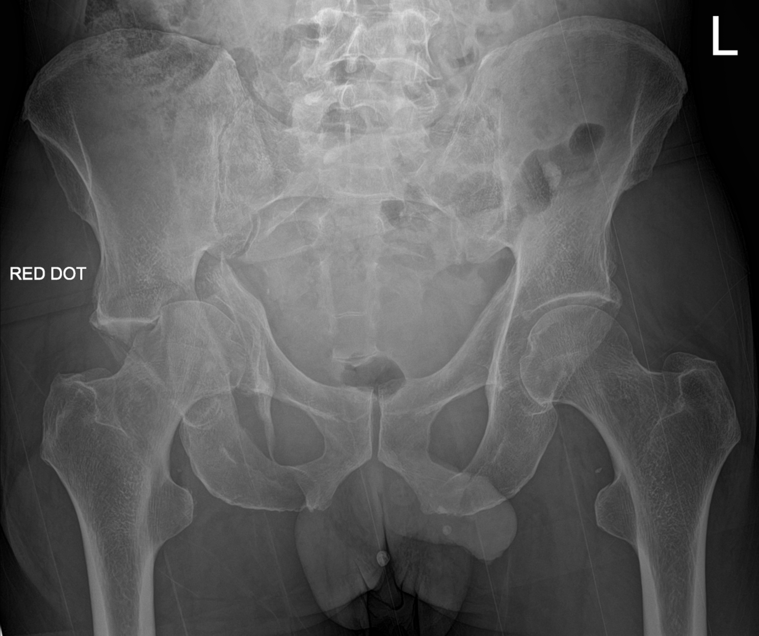 Trật khớp háng trung tâm (Central hip dislocation)
