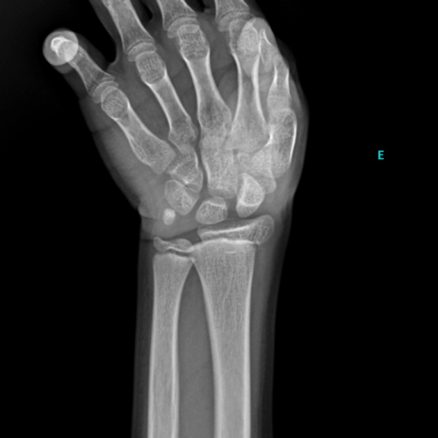 Gãy sụn tiếp hợp (Gãy Salter-Harris)