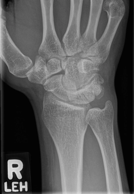 Gãy xương đậu (Pisiform fracture)