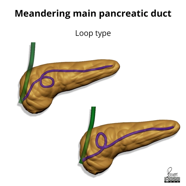 Ống tụy chính ngoằn ngoèo (Meandering main pancreatic duct)