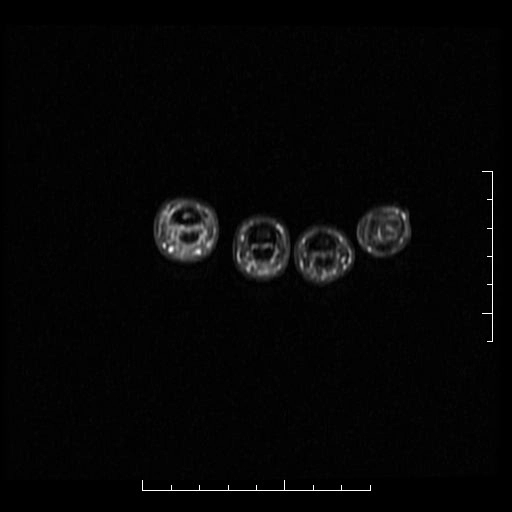 Tổn thương dây chằng bên của ngón tay (Collateral ligament injury of finger)