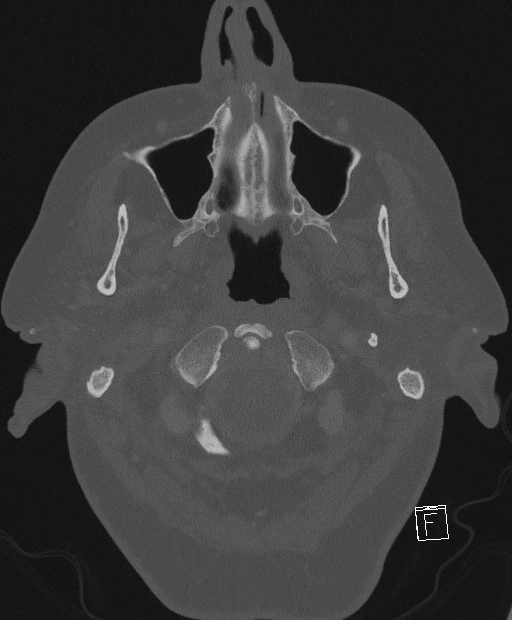 Ung thư biểu mô tế bào vảy ống tai ngoài (External Auditory Canal Squamous Cell Carcinoma - EAC SCCa)
