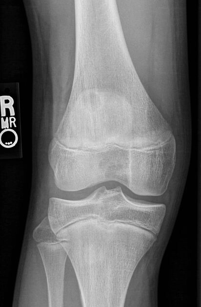 Khuyết mặt sau xương bánh chè (Dorsal defect of the patella)