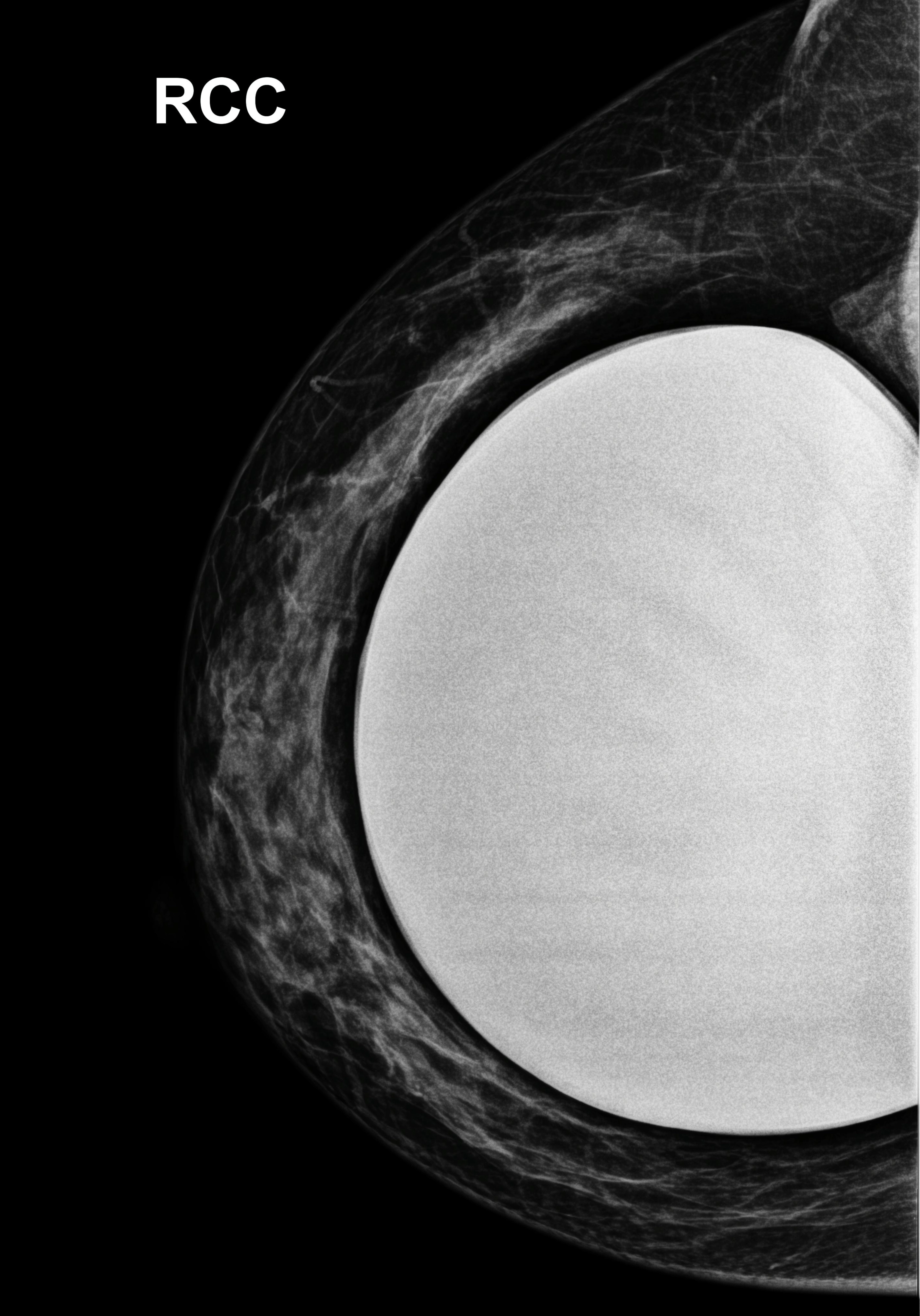 Tăng sản ống không điển hình (Atypical ductal hyperplasia)
