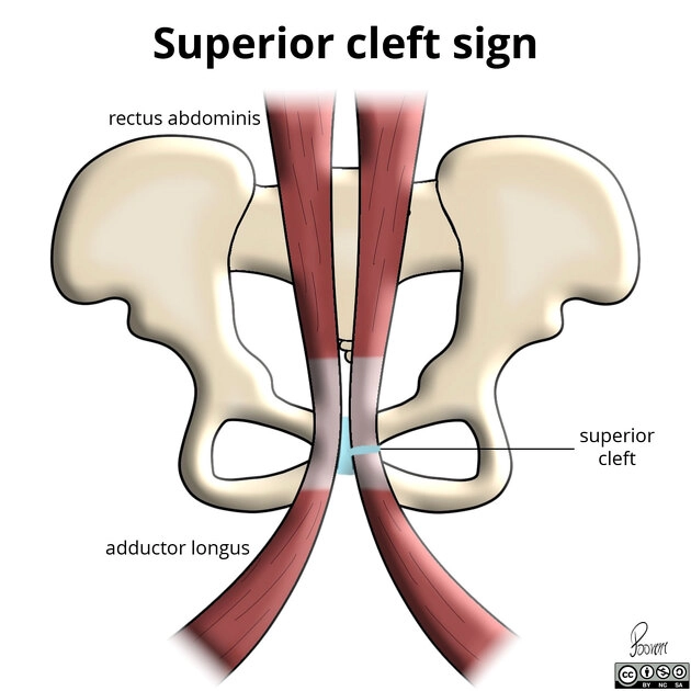 Đau bẹn ở vận động viên (Athletic Pubalgia)