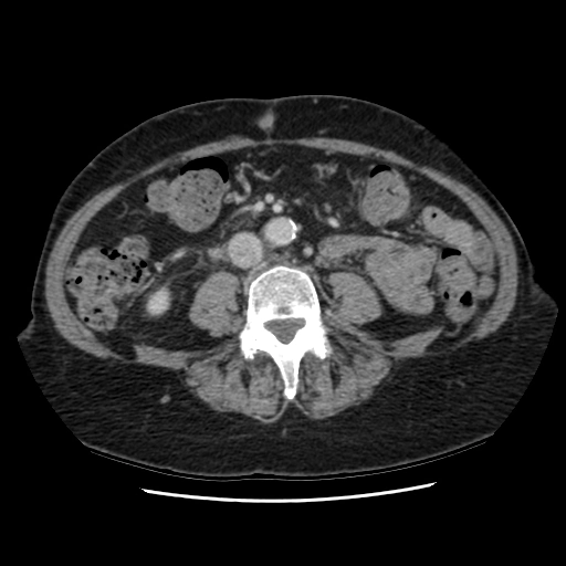 Lymphoma sau phúc mạc (Retroperitoneal lymphoma)